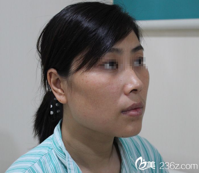 【下頜角+顴骨】一位媽媽做顴骨和下頜角的經(jīng)歷。