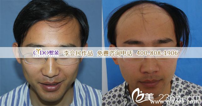 　　丁先生自述：　　我是一名高級(jí)工程師。由于遺傳和工作壓力，