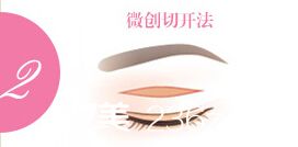 1422507109749471.jpg 微創(chuàng)2.jpg