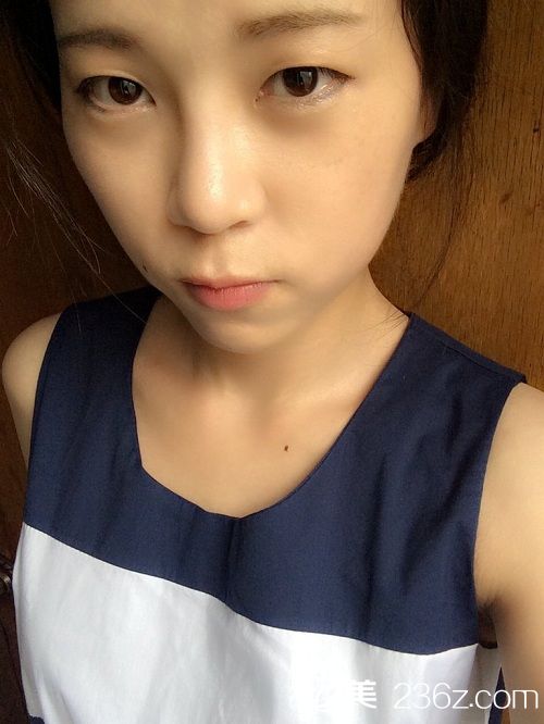 我做隆鼻手術已經(jīng)過去2個月了，雖然做了手術，但是大家都覺得很