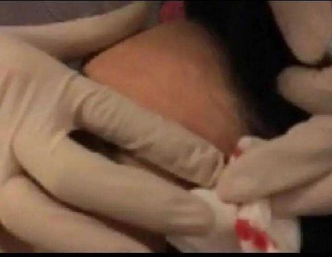 居然用紙巾為求美者擦血！