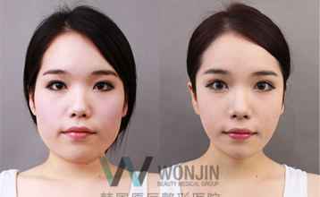 高顴骨太陽(yáng)穴凹陷—韓國(guó)原辰整形醫(yī)院—顴骨案例