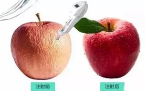 玻尿酸注射效果對(duì)比