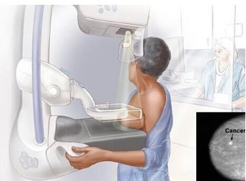 乳癌篩查 隆胸