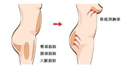 自體脂肪豐胸 麥恩醫(yī)院