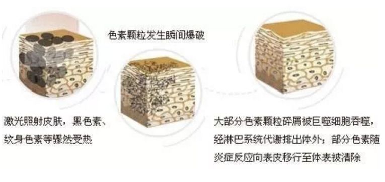 激光祛斑原理