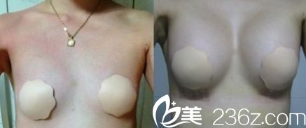 韓國(guó)麥恩醫(yī)院李圣郁院長(zhǎng)圓形和水滴形假體植入之后躺著的樣子