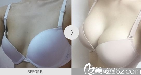 韓國(guó)麥恩醫(yī)院李圣郁院長(zhǎng)自體隆胸案例