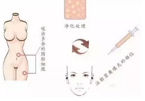 自體脂肪填充面部過(guò)程