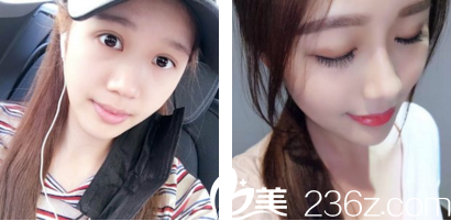 百麗達(dá)鼻綜合案例