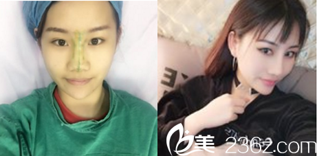 余天成鼻綜合案例