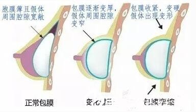 北京葉子整形美容醫(yī)院假體隆胸遵循的乳房黃金五線標(biāo)準(zhǔn)介紹薄膜攣縮圖