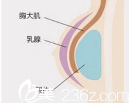 北京葉子整形美容醫(yī)院假體隆胸采用雙平面假體植入圖