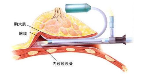 北京葉子整形美容醫(yī)院假體隆胸采用內(nèi)窺鏡假體植入法