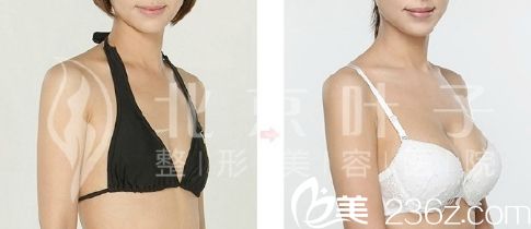 北京葉子整形美容醫(yī)院假體隆胸的魯禮新院長(zhǎng)的手術(shù)案例