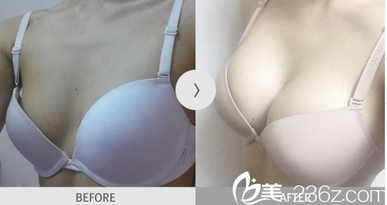 北京葉子整形美容醫(yī)院假體隆胸的魯禮新院長(zhǎng)的手術(shù)案例3