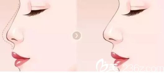 北京葉子美容醫(yī)院隆鼻