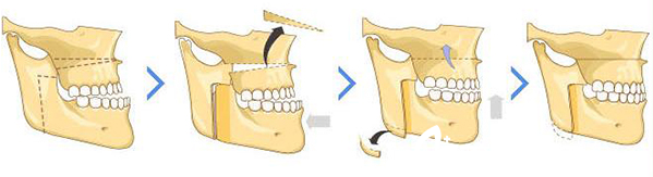 雙鄂修復(fù)手術(shù)—韓國id醫(yī)院—手術(shù)方案