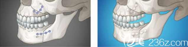 雙鄂修復(fù)手術(shù)—韓國id醫(yī)院—術(shù)中鈦釘固定