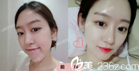 雙鄂修復(fù)手術(shù)—韓國id醫(yī)院樸相薰院長案例1