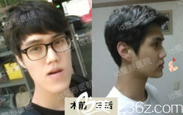 雙鄂修復(fù)手術(shù)—韓國id醫(yī)院樸相薰院長男生案例