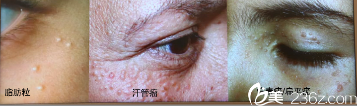 韓國童顏中心—具昭彥院長(zhǎng)—激光去除脂肪粒