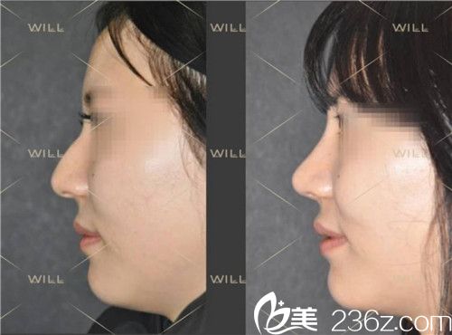 will醫(yī)院硅膠隆鼻整形案例術(shù)前術(shù)后對(duì)比