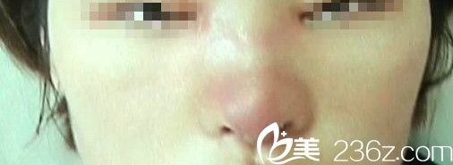 鼻整形后腫脹發(fā)癢