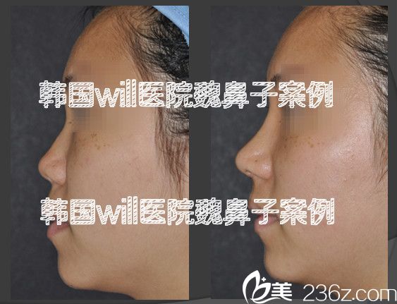 韓國(guó)will醫(yī)院魏鼻子案例