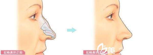 駝峰鼻矯正術 駝峰鼻矯正術