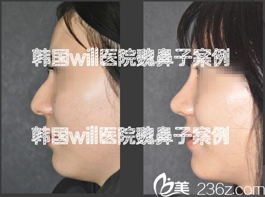 韓國will醫(yī)院魏鼻子駝峰鼻矯正案例 韓國will醫(yī)院魏鼻子駝峰鼻矯正案例
