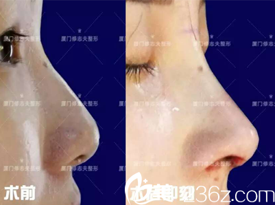 廈門修志夫短鼻—鼻綜合整形