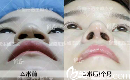 廈門修志夫鼻孔不一，鼻孔橫臥——鼻綜合整形鼻孔不一，鼻孔橫臥——鼻綜合整形
