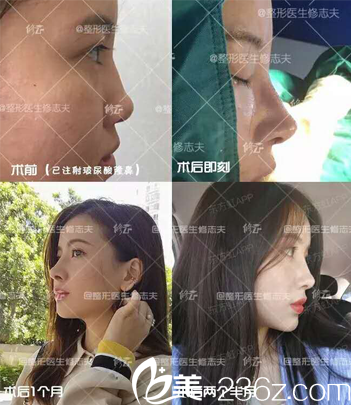 廈門修志夫網(wǎng)紅小翹鼻打造——鼻綜合整形