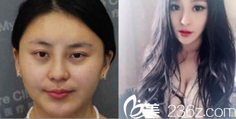 北京米揚(yáng)麗格巫文云鼻頭矮，鼻梁低——鼻綜合整形