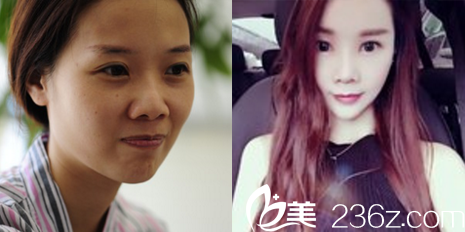 北京米揚(yáng)麗格巫文云鼻翼過(guò)大，鼻孔外露——鼻綜合整形