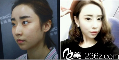 北京米揚(yáng)麗格駝峰鼻—鼻綜合整形