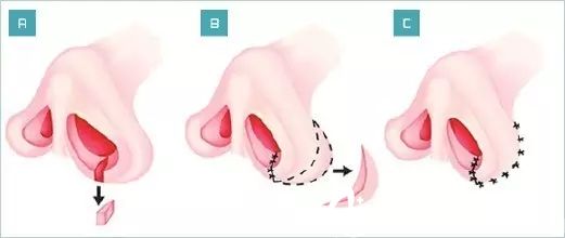 鼻翼縮小切除鼻翼游離緣