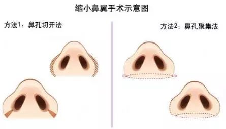 縮小鼻翼手術(shù)