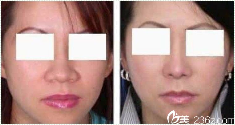 鼻翼縮小術(shù)真人案例