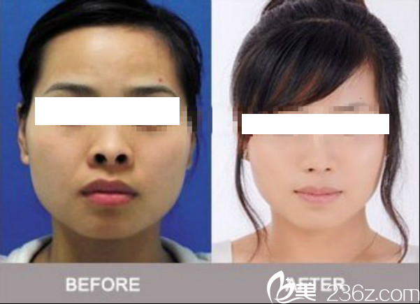 韓國will醫(yī)院魏亨坤院長鼻孔縮小術(shù)案例