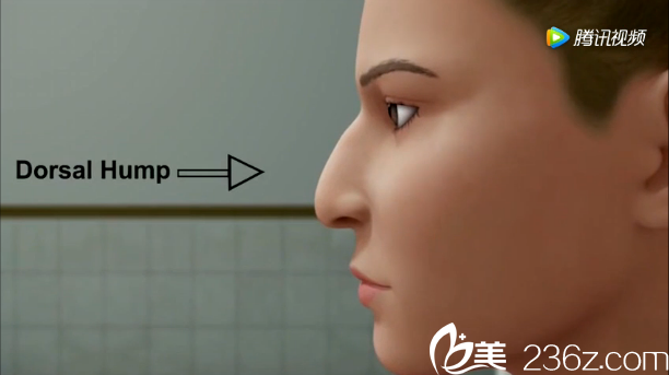 韓國will醫(yī)院駝峰鼻矯正示意圖