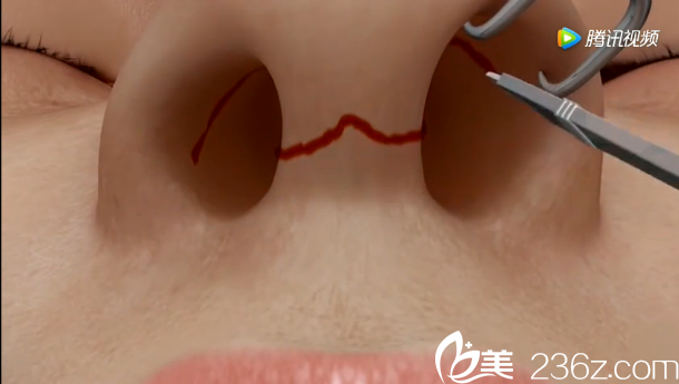韓國will醫(yī)院駝峰鼻矯正——沿著鼻孔內(nèi)沿做碟形切口