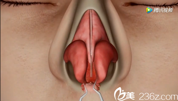 韓國will醫(yī)院駝峰鼻矯正—分離出一個完整的鼻部腔隙