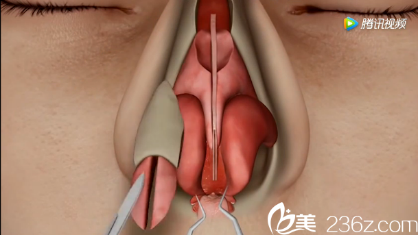 韓國will醫(yī)院駝峰鼻矯正—切除多余的駝峰組織部分