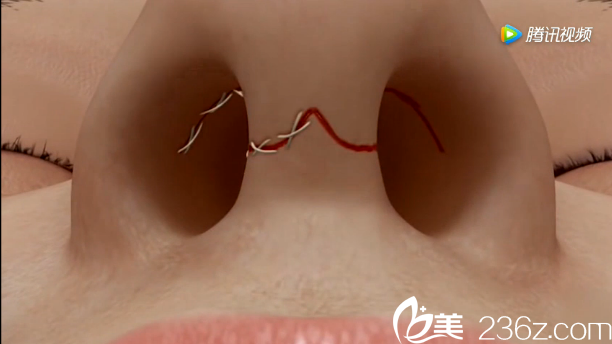 韓國will醫(yī)院駝峰鼻矯正—縫合手術(shù)切口