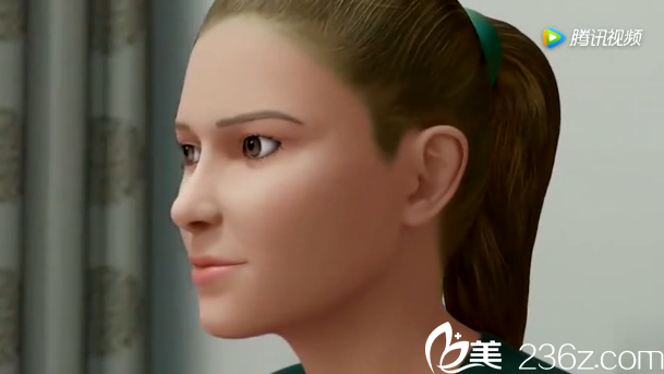 韓國will醫(yī)院鼻子矯正效果