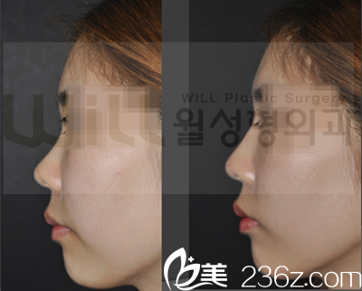 韓國will醫(yī)院魏亨坤院長手術(shù)案例