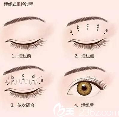 北京京民醫(yī)院埋線雙眼皮的圖例