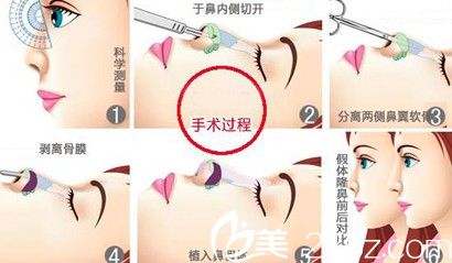 假體隆鼻手術(shù)過程示意圖